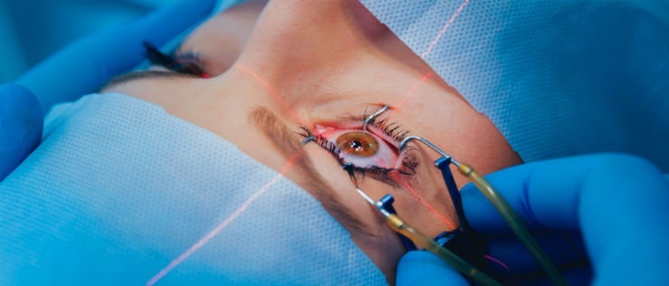 5 Things to Know Before Your Cataract Surgery